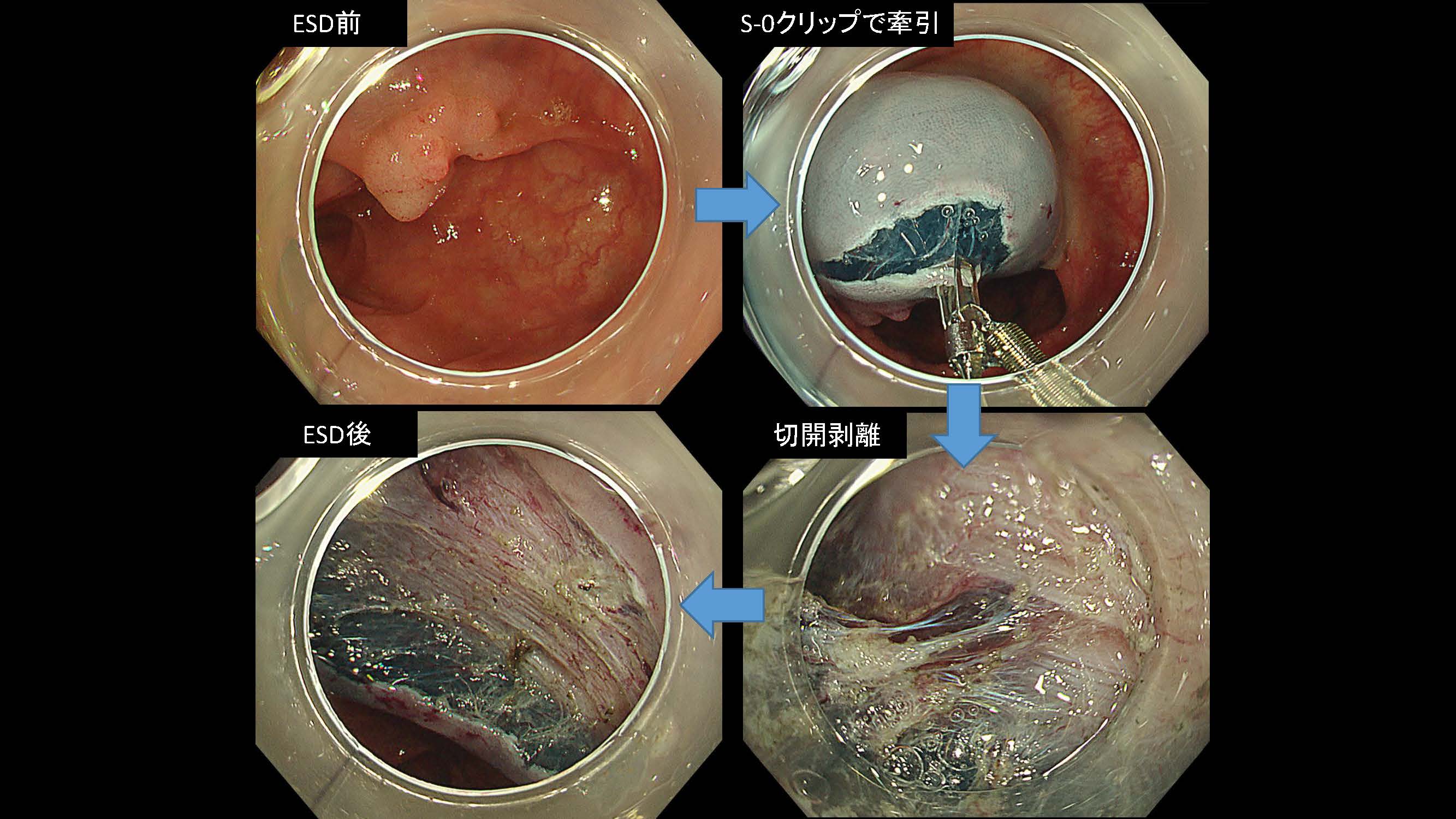 大腸020